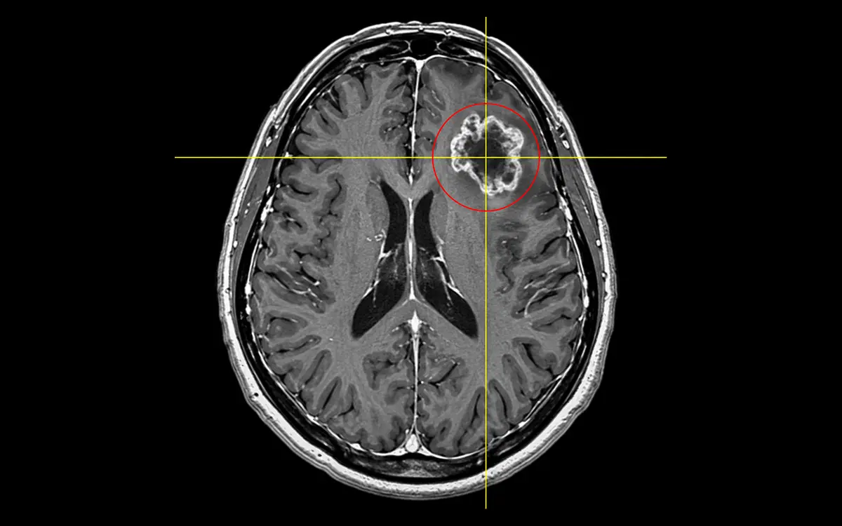 兼顧腦瘤切除與神經功能：魏國珍團隊的手術策略與治療突破