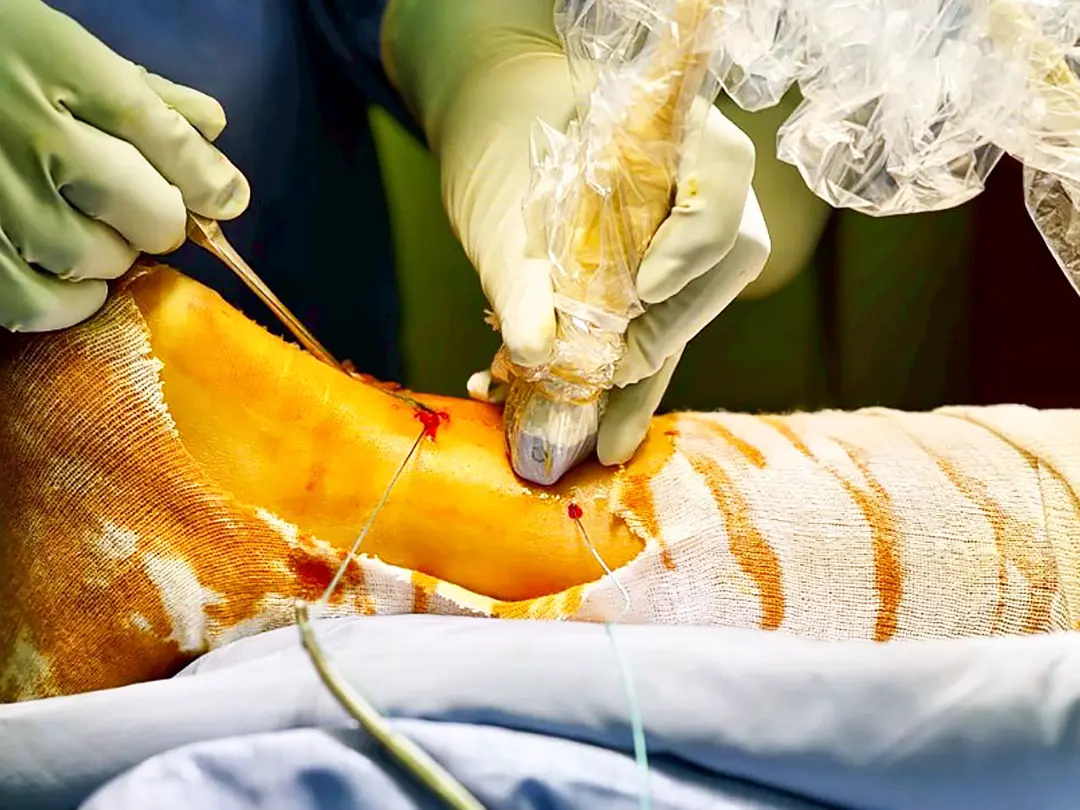 MIS for Achilles tendon rupture repair