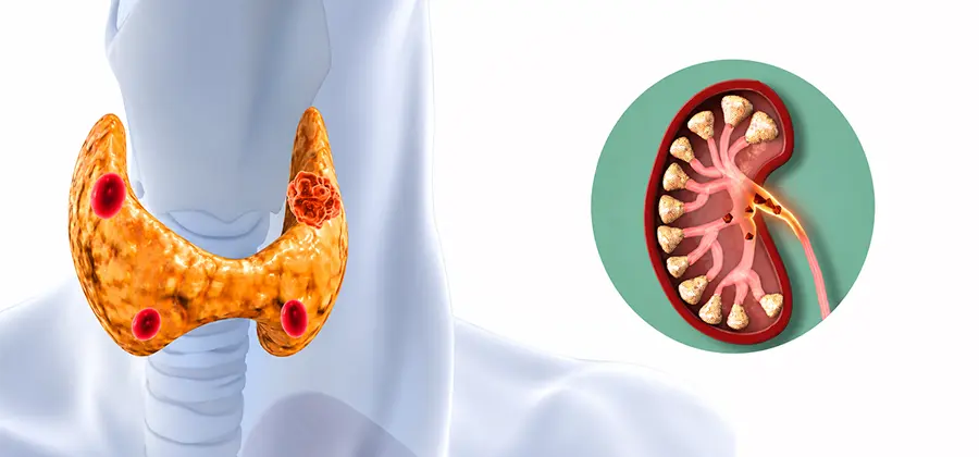 次發性副甲狀腺亢進