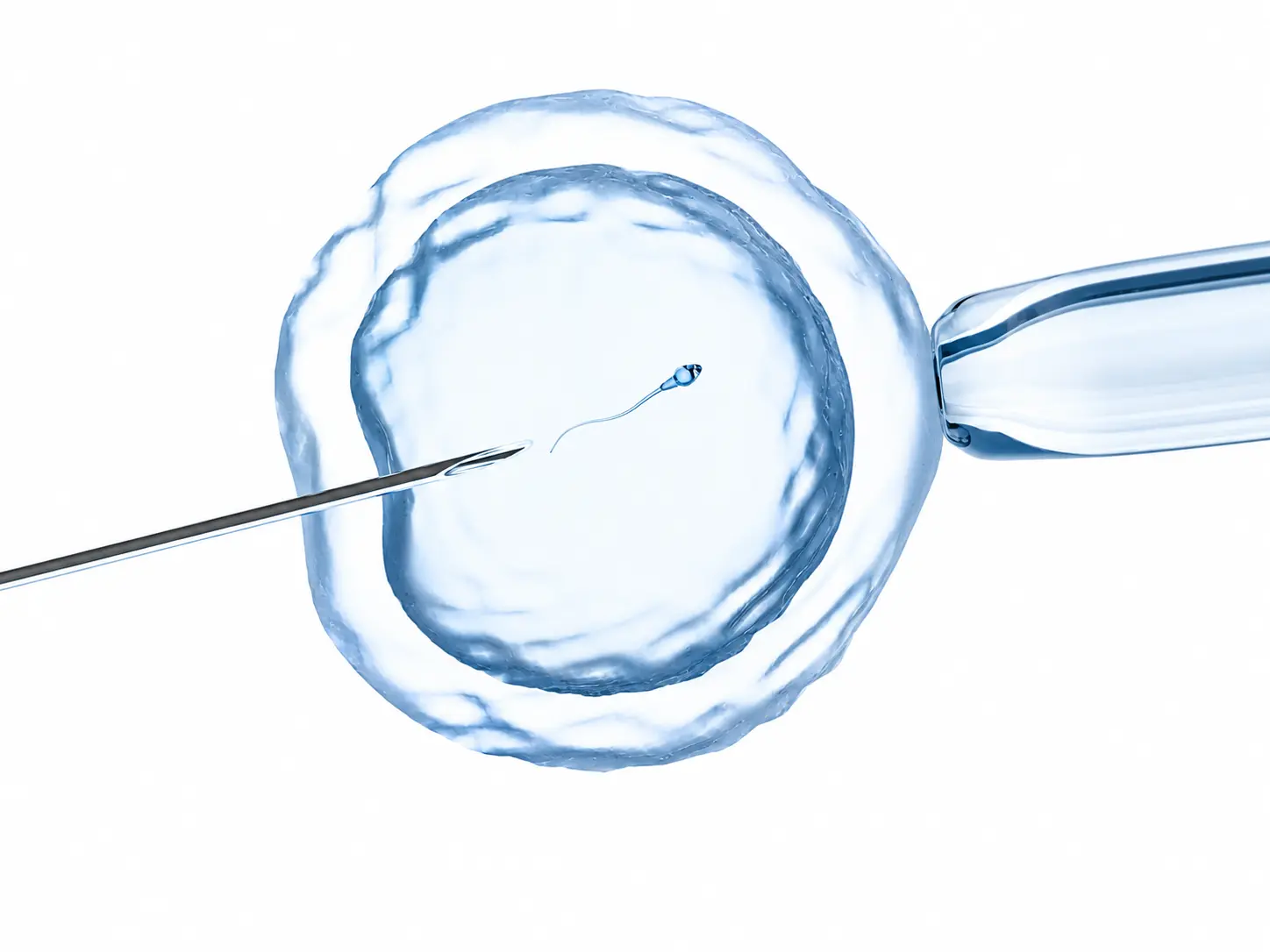 Assisted Reproduction for Infertility