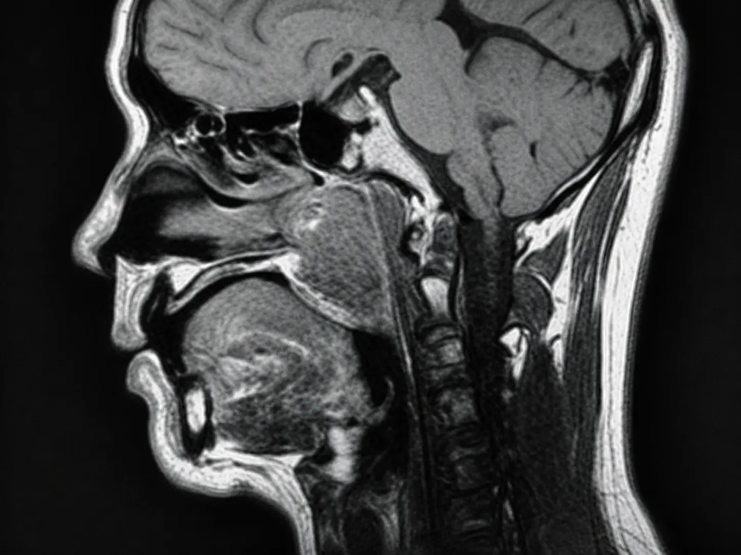 Bone & Soft Tissue Tumor Pathology