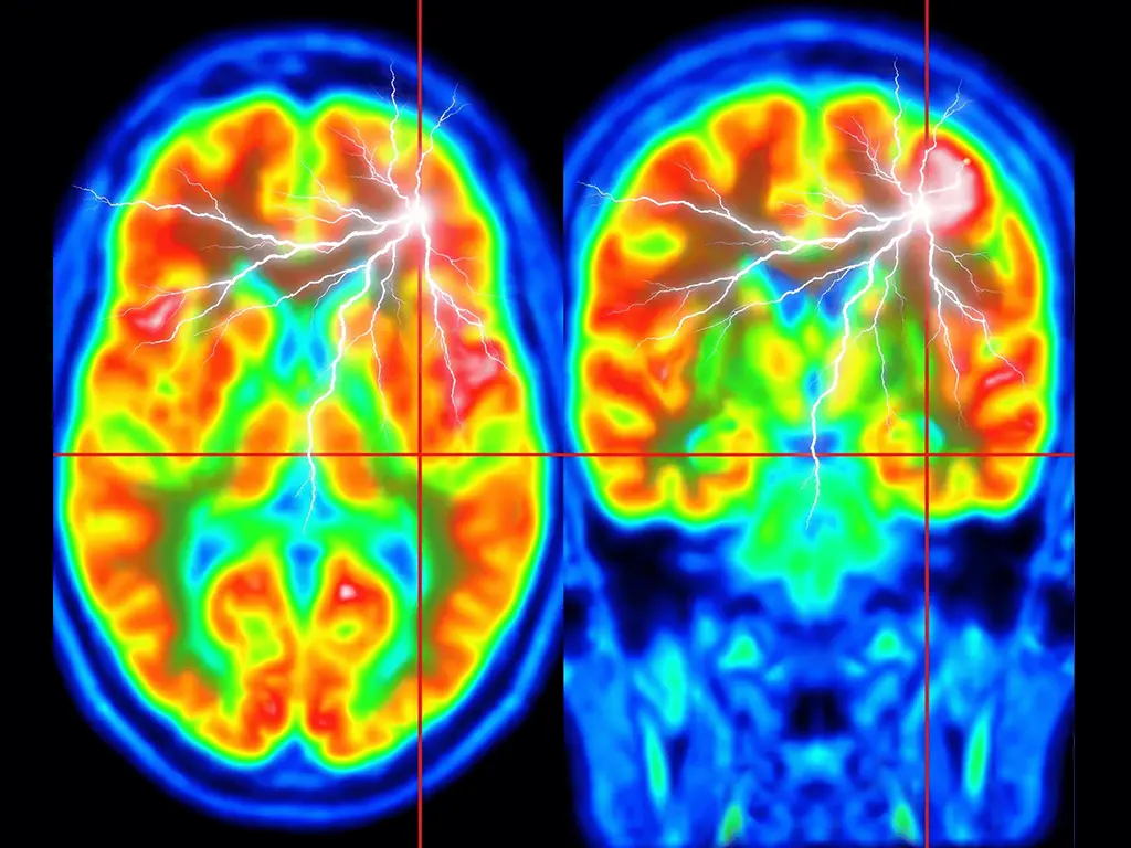 Surgery of Drug-Resistant Epilepsy