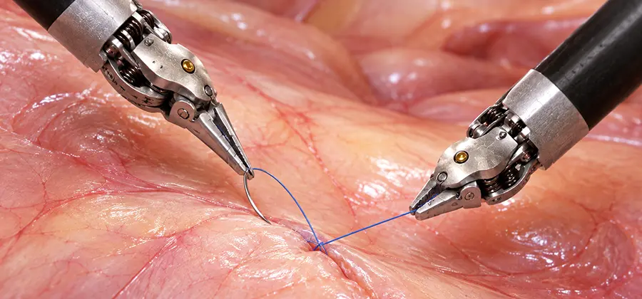 Robotic Pancreatic Surgery