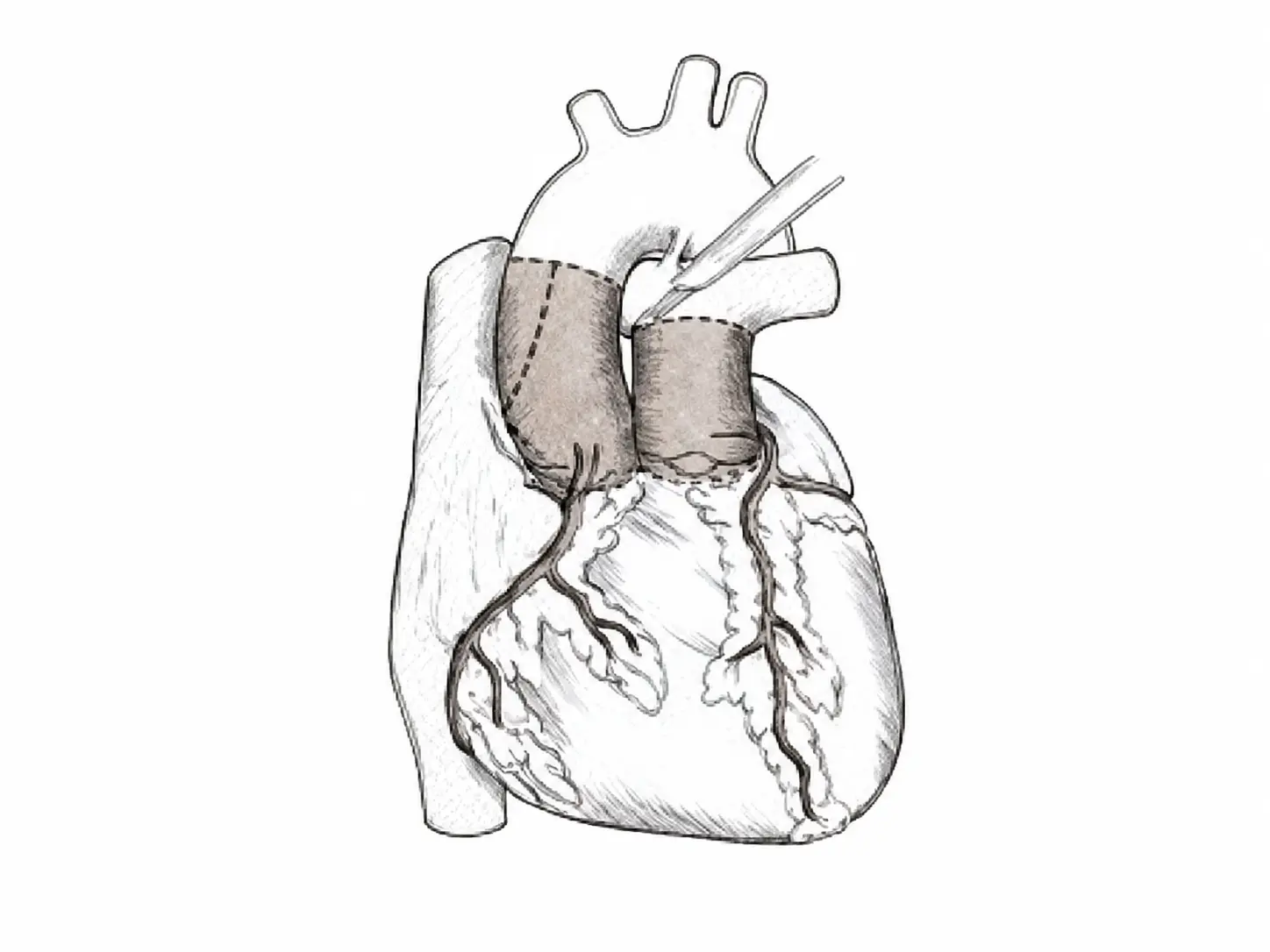 Cardiovascular tissue bank