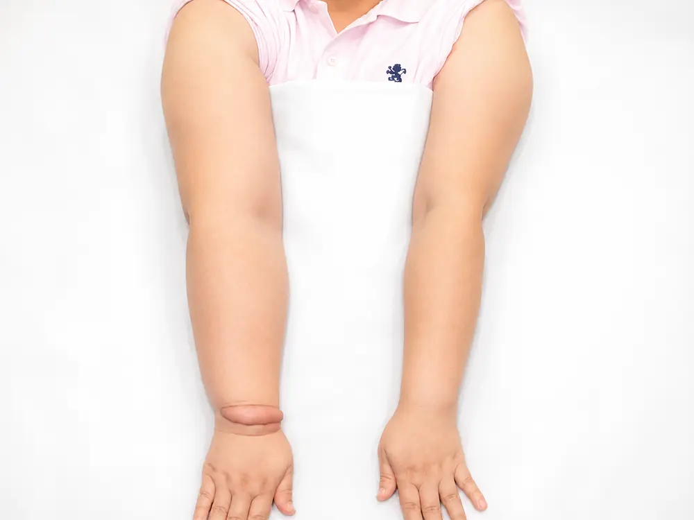 Precision Treatment of Lymphedema