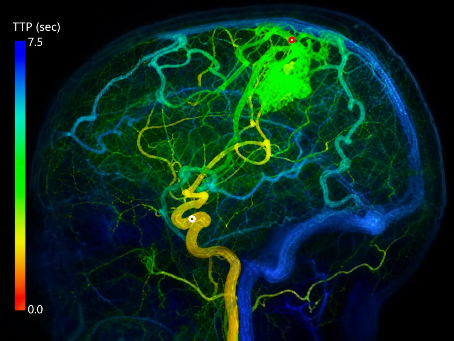 Gamma Knife Treatment for Cerebral AVMs