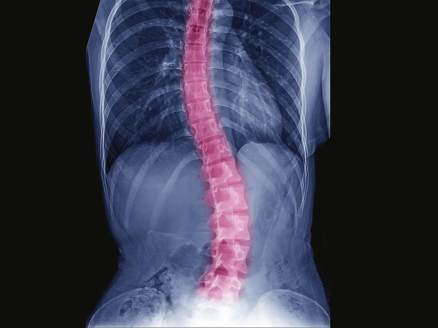 Comprehensive Scoliosis Correction Care