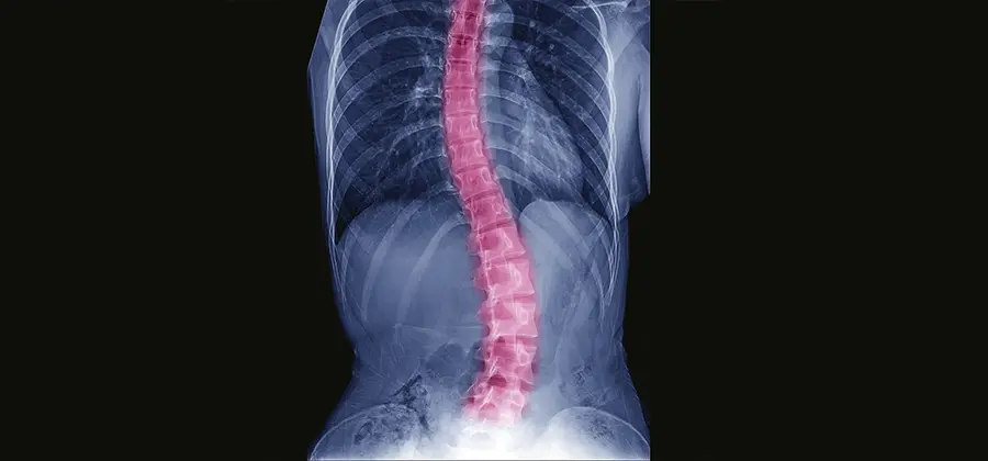 Comprehensive Scoliosis Correction Care