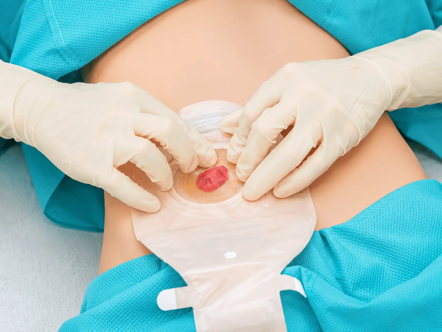 Bright life with ostomy holistic care.