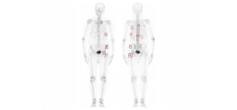 China Medical University Hospital Computer-aided triage platform for bone scintigraphy