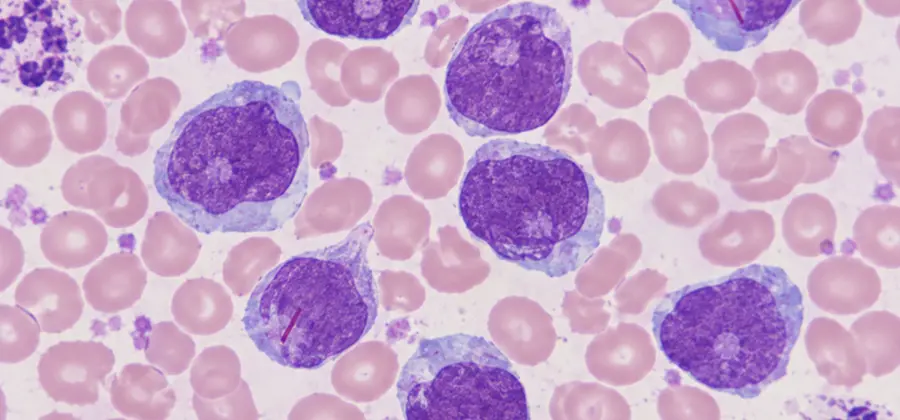 Improving the quality of childhood cancer care; achieving a world-class treatment outcome for pediatric acute myeloid leukemia
