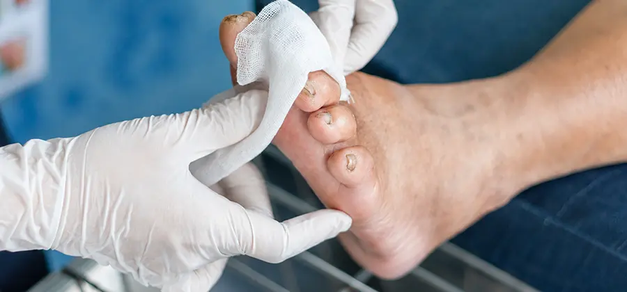 Integrated Care for Diabetic Foot Ulcer