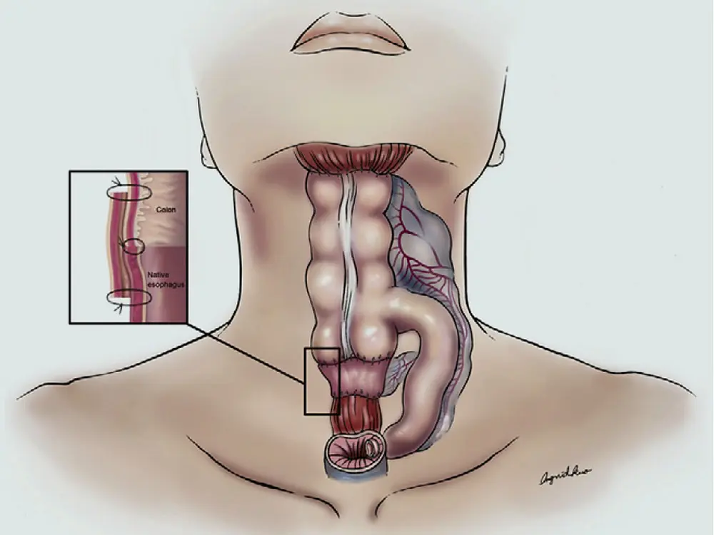 Ileocolon Flap for Vocal Cord Repair