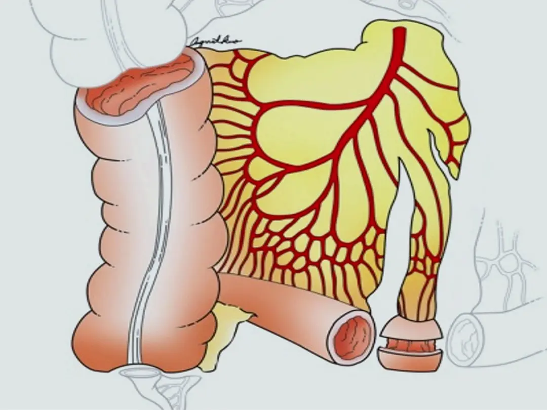 Ileocolon Flap for Vocal Cord Repair