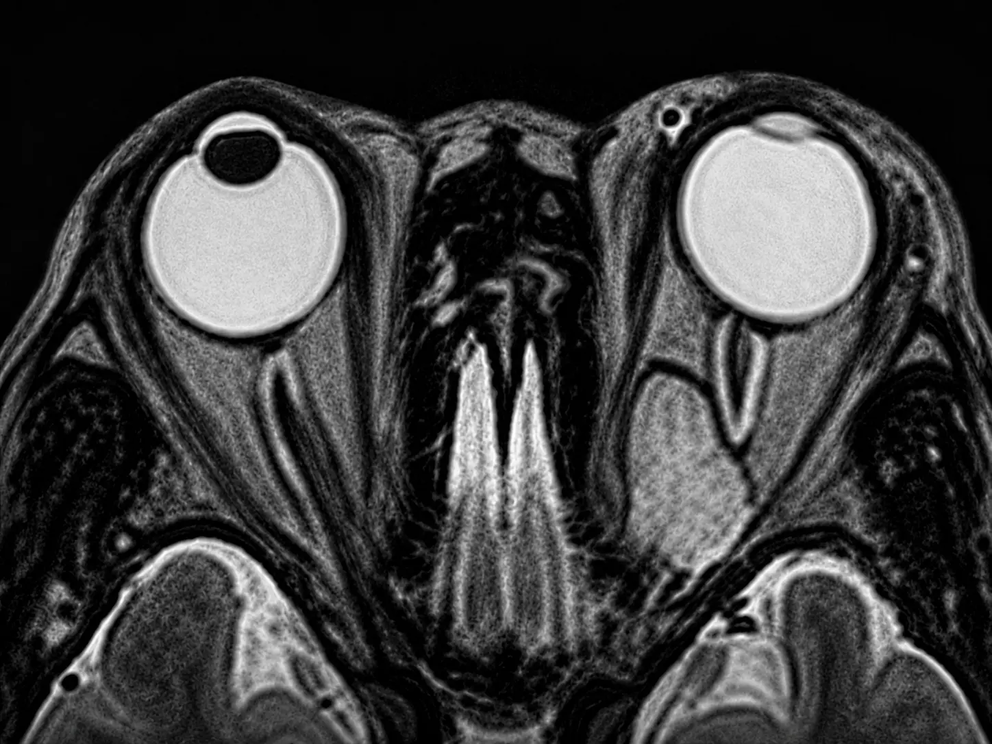 Brain Tumors & AVMs