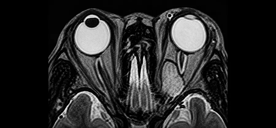 腦瘤血管病變