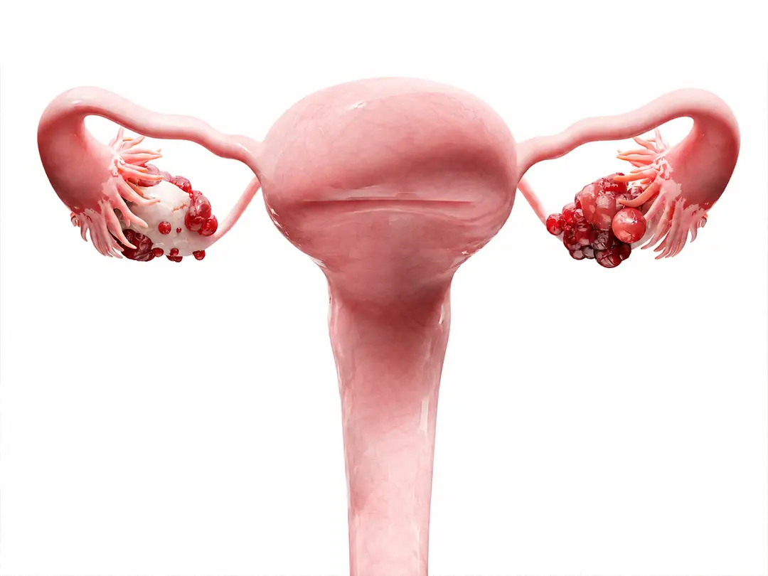 Gynecologic cancer