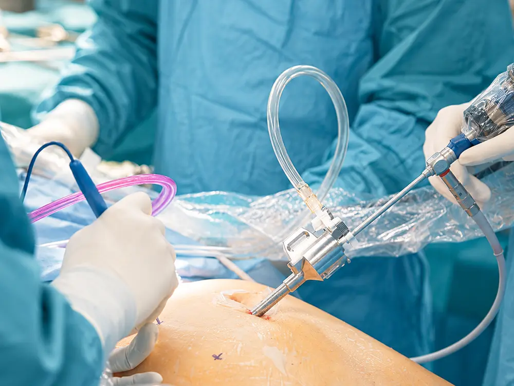 Single-Port Laparoscopic Bile Duct Exploration