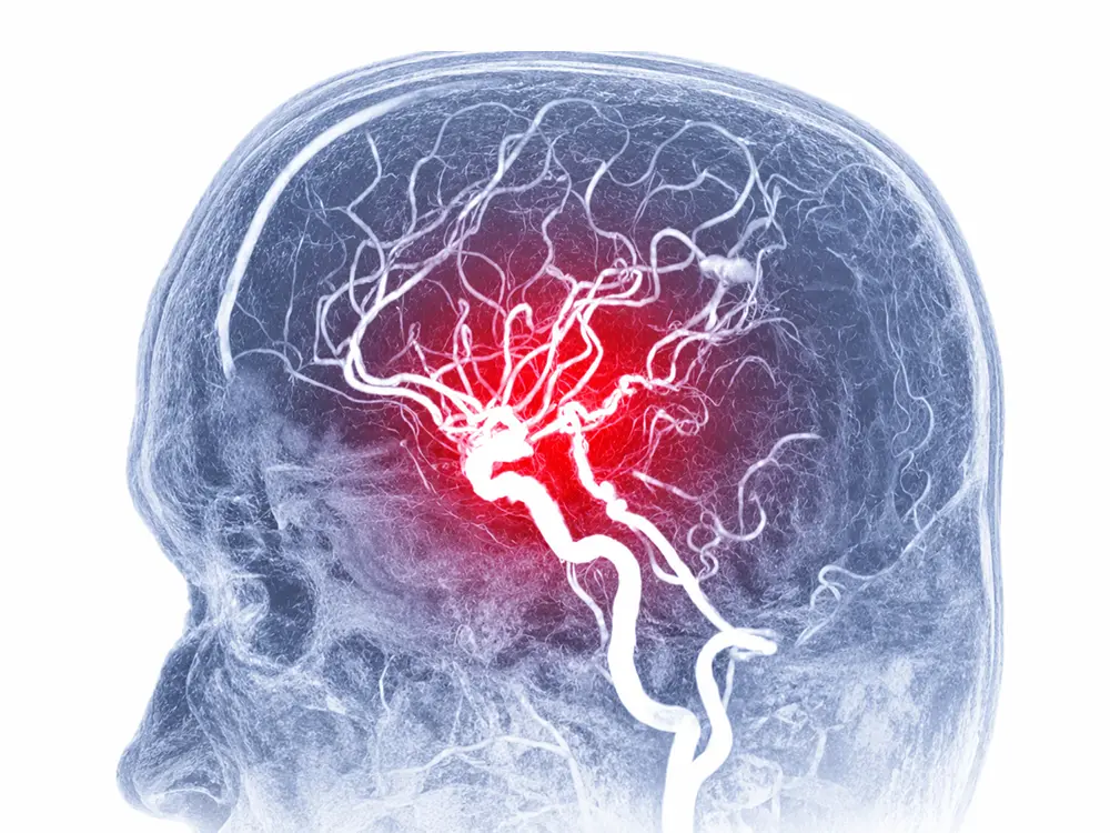 Acute Stroke Care