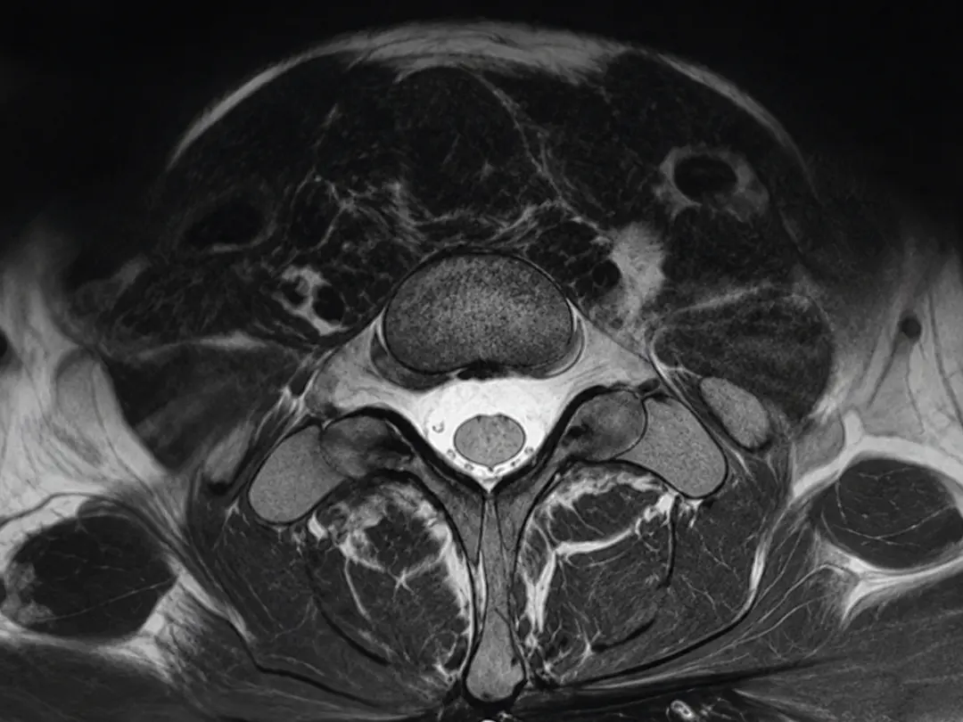 Blood Patch for Intracranial Hypotension