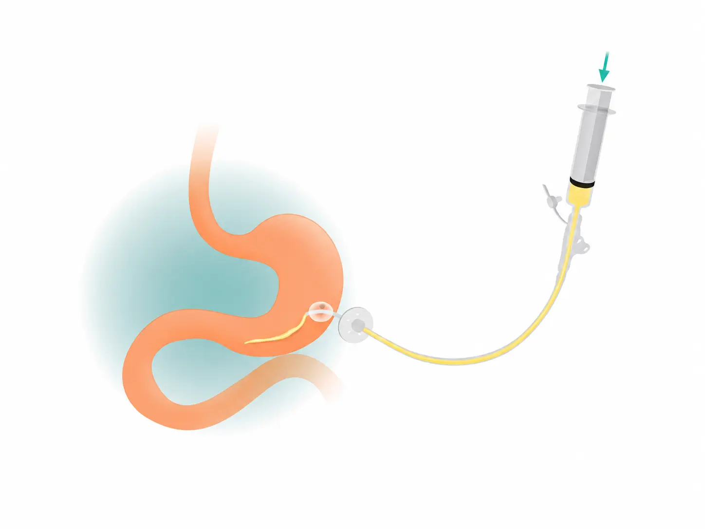PEG Tube Care & Case Management