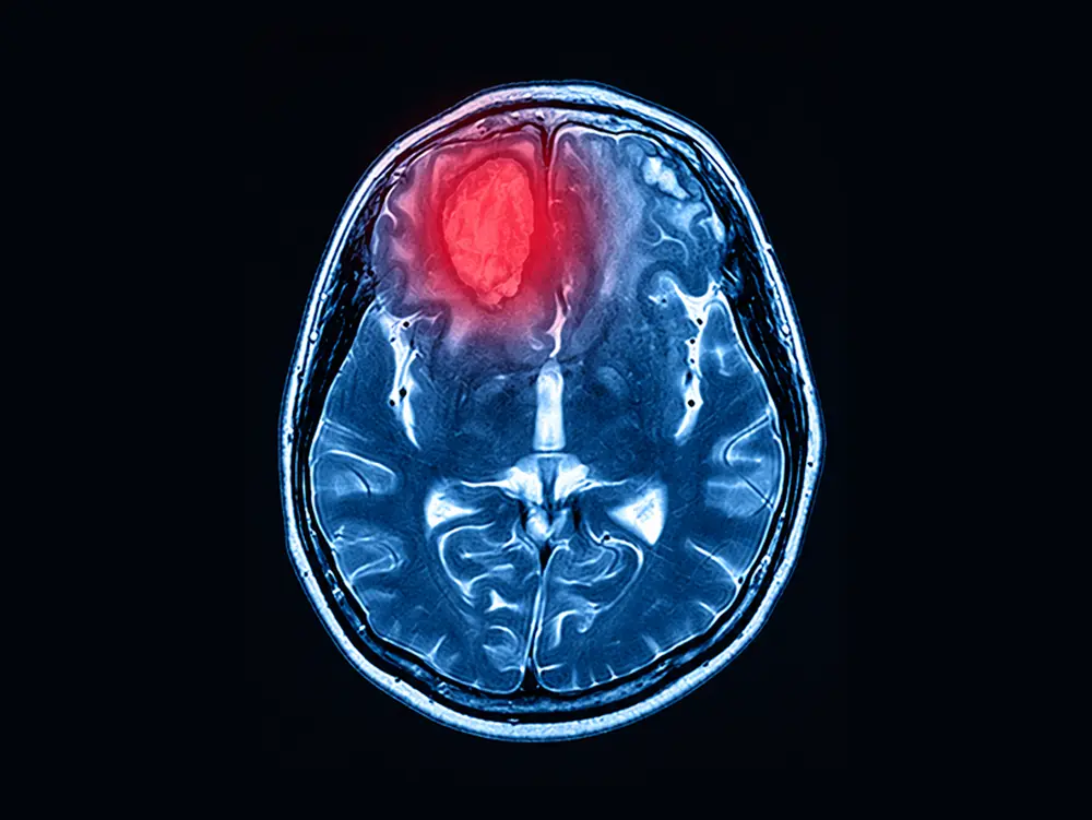 Neurovascular Intervention