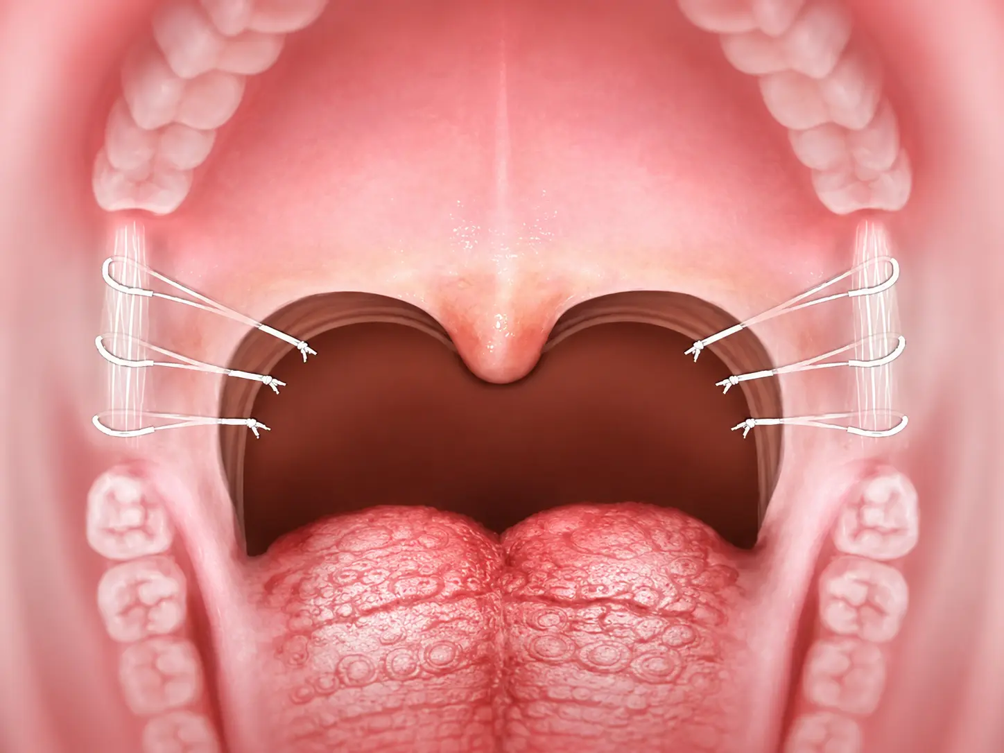 Pharyngeal Surgery for Sleep Apnea