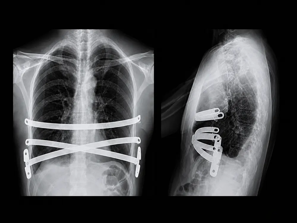 Nuss procedure : Team Medical care model