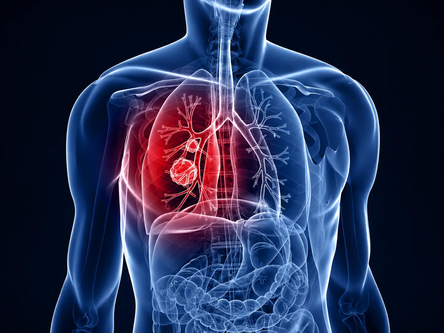Precision Management of Pulmonary Nodule