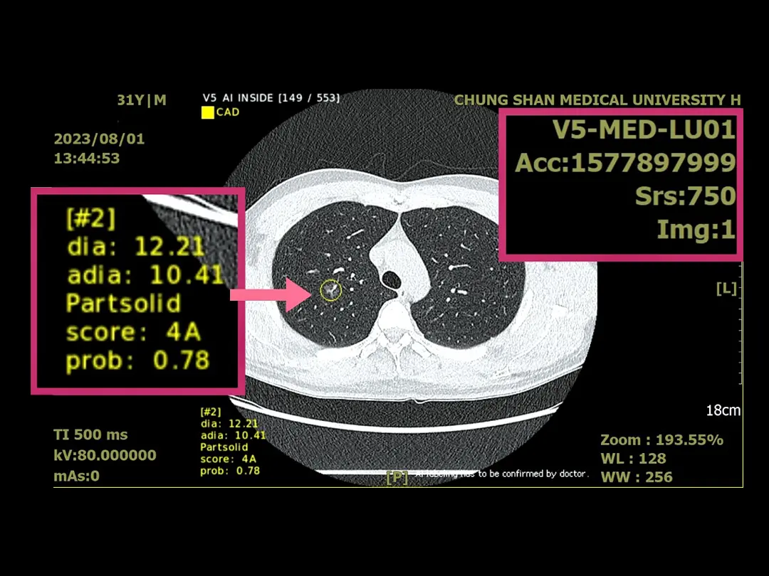 Precision Management of Pulmonary Nodule