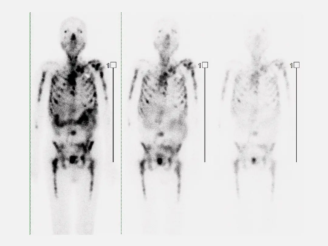 Lu-177 Radioligand Therapy