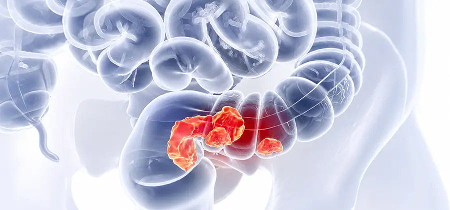 Comprehensive Colorectal Cancer Care
