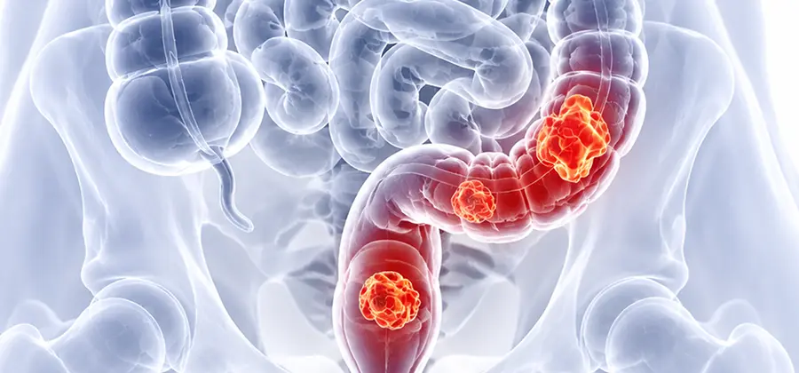 Comprehensive Colorectal Cancer Care