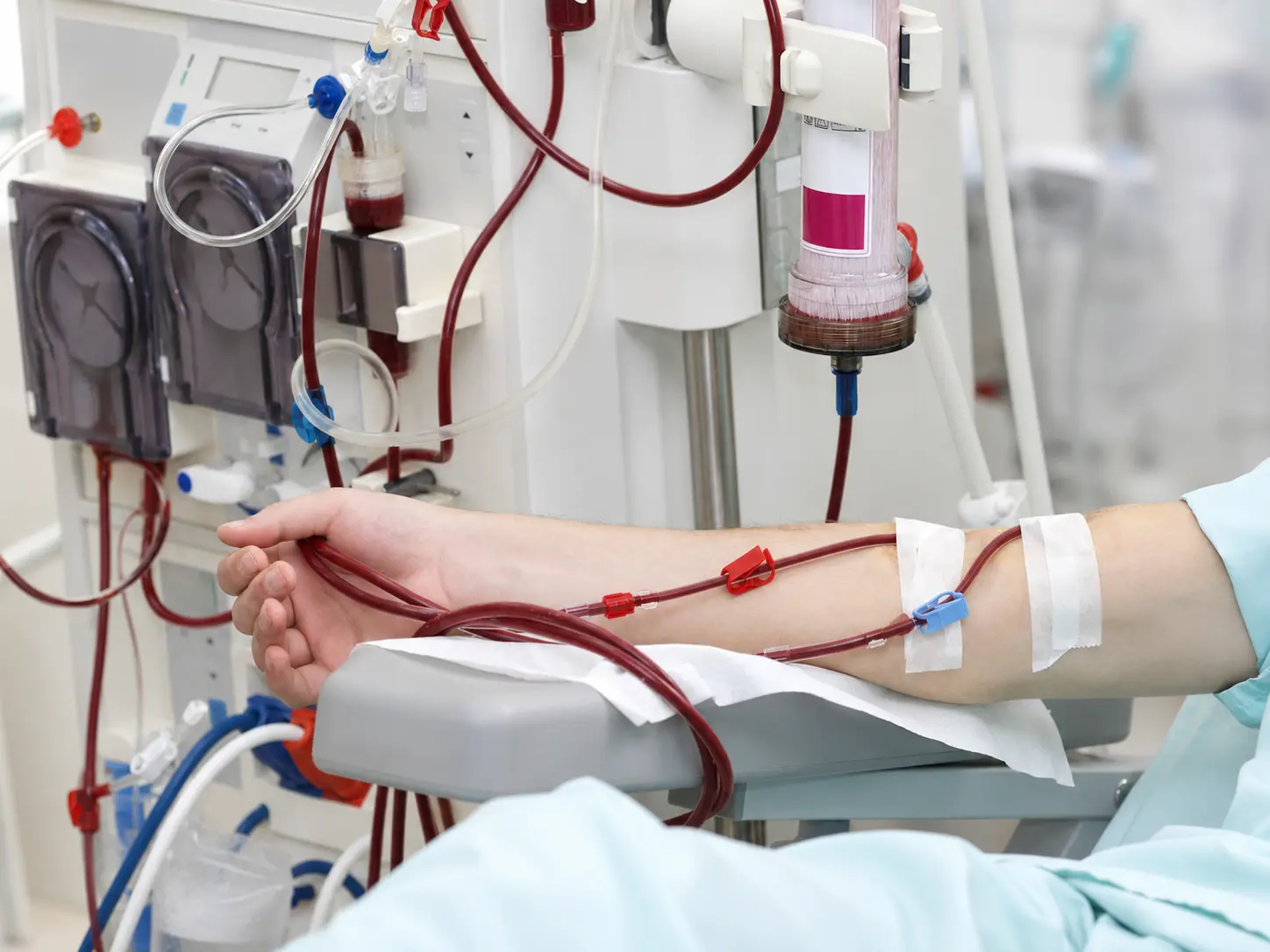 AI Prediction Intradialytic Hypotension