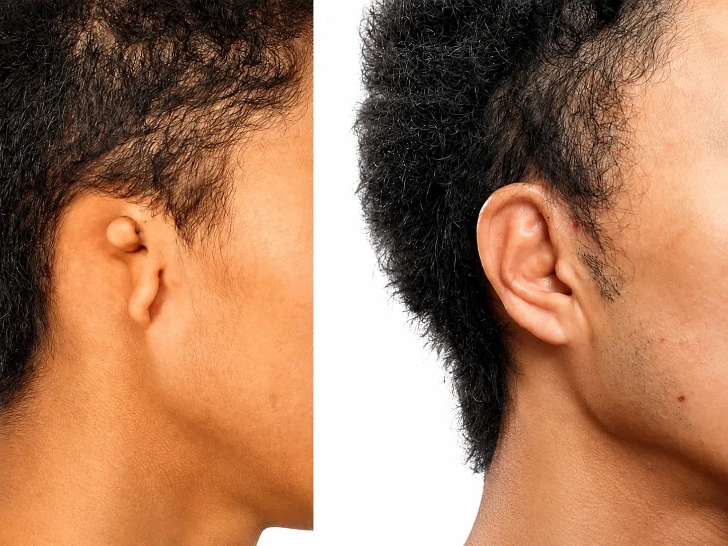 Microtia Ear Reconstruction