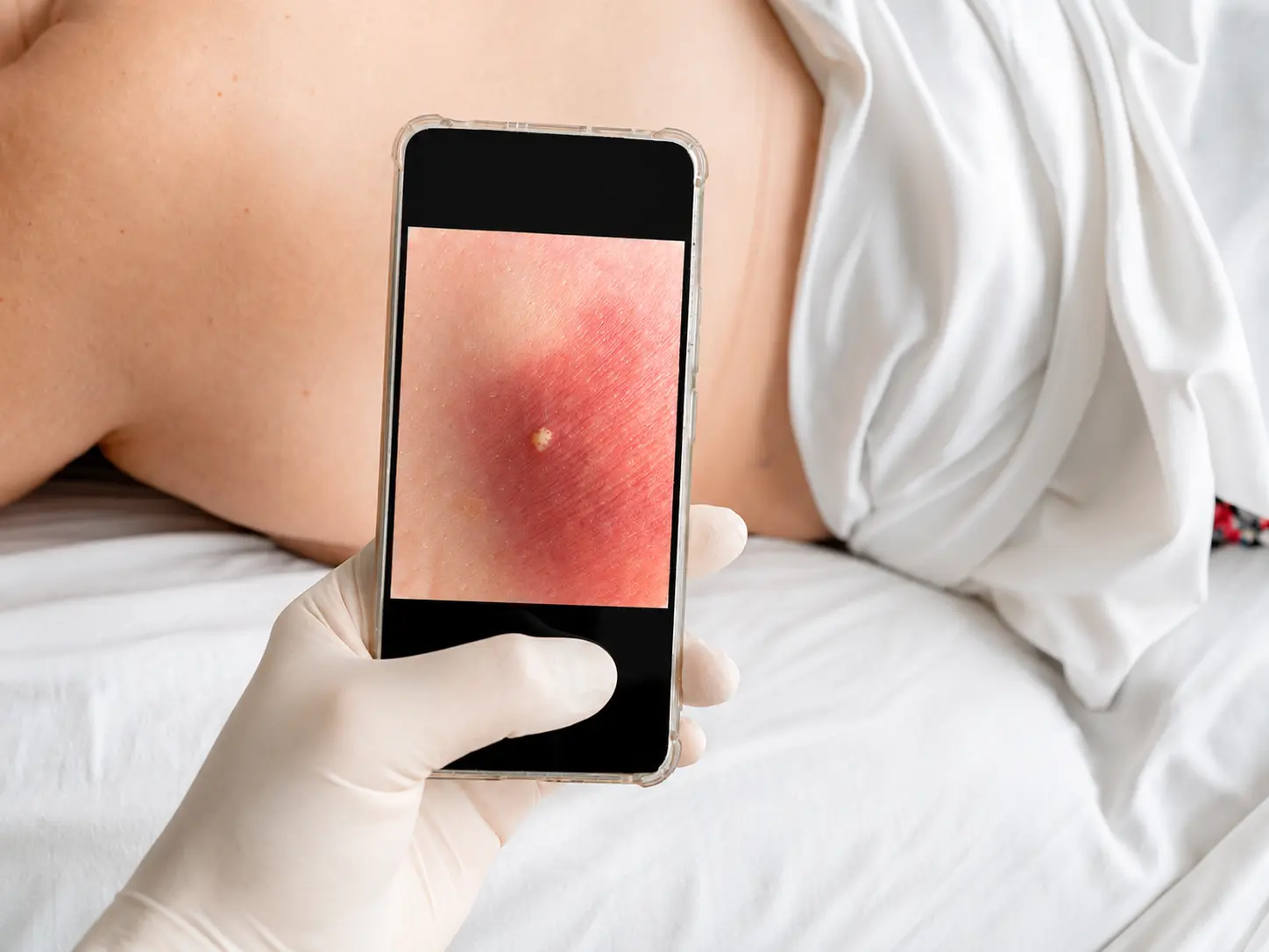 Telecare for Peripheral Vascular Disease