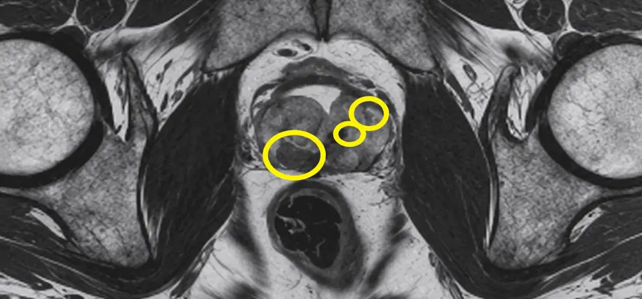 Radical Surgery for Locally Advanced Prostate Cancer