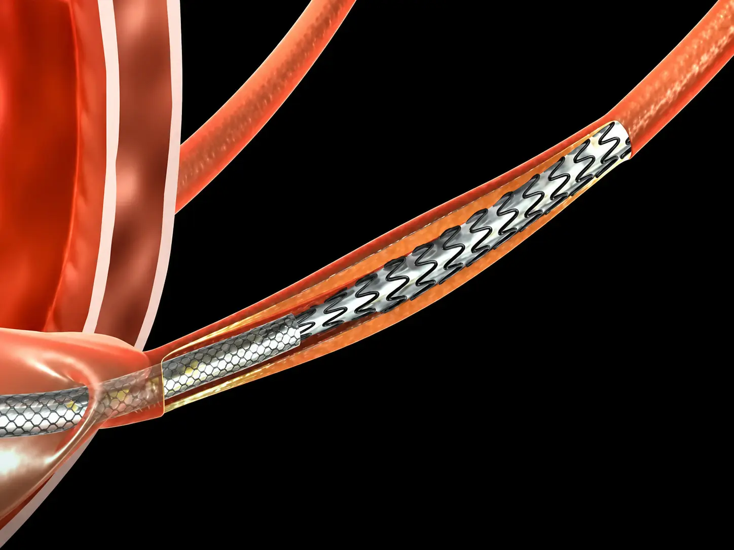 Metallic Stent for Ureteral Stricture