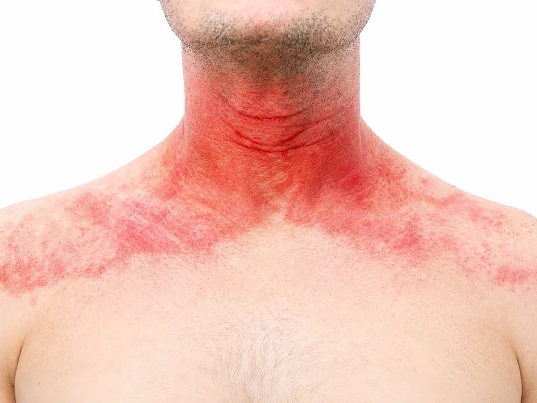 Skin Care for Head & Neck Cancer Radiotherapy
