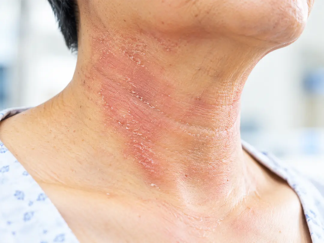 Skin Care for Head & Neck Cancer Radiotherapy