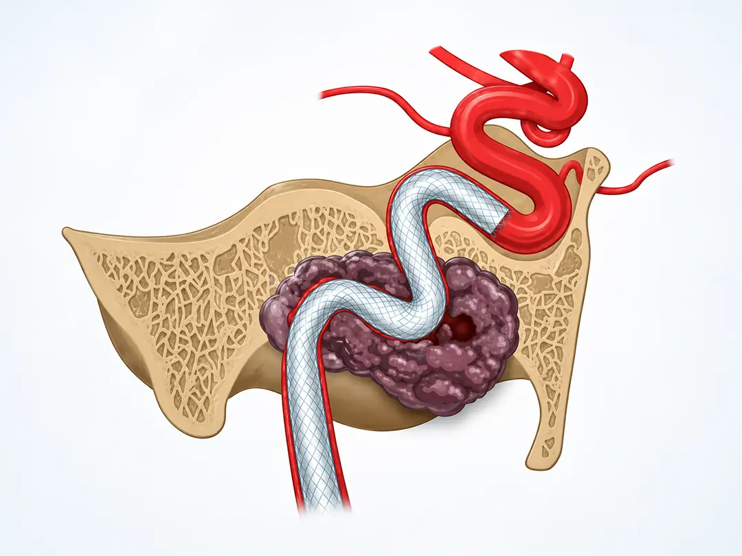 Stent-Graft Treatment for Carotid Blowout