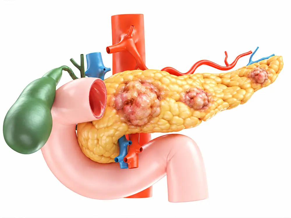 Comprehensive Pancreatic Care & Training