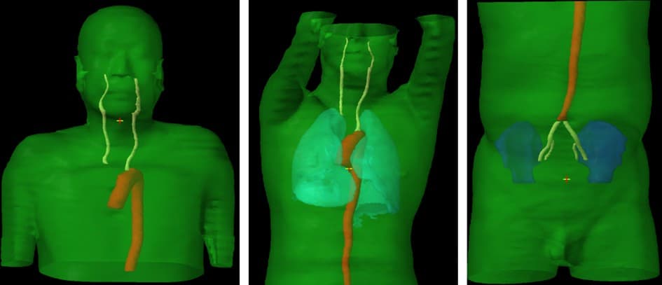 AI-assisted carotid arteries identification for optimized smart prep technique in slow contrast computed tomography Simulation