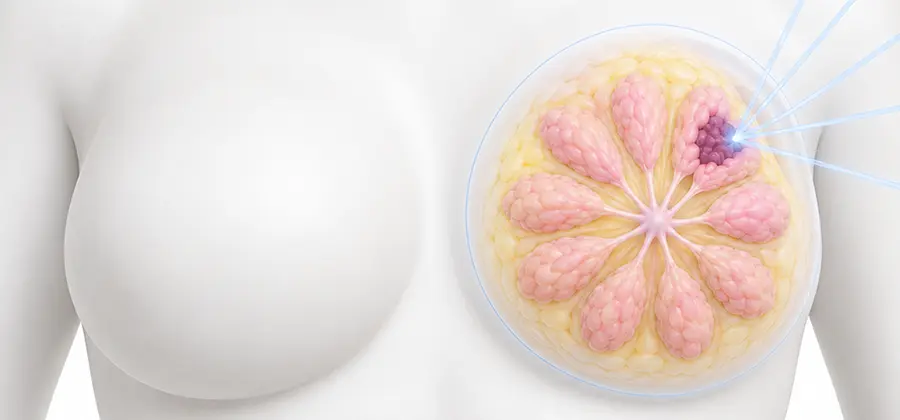 精準呼吸調控乳癌放射治療