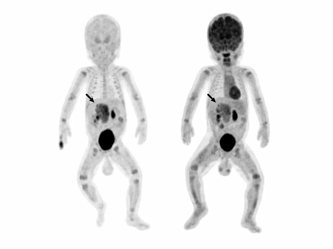 Precision Therapy for Pediatric Neuroblastoma