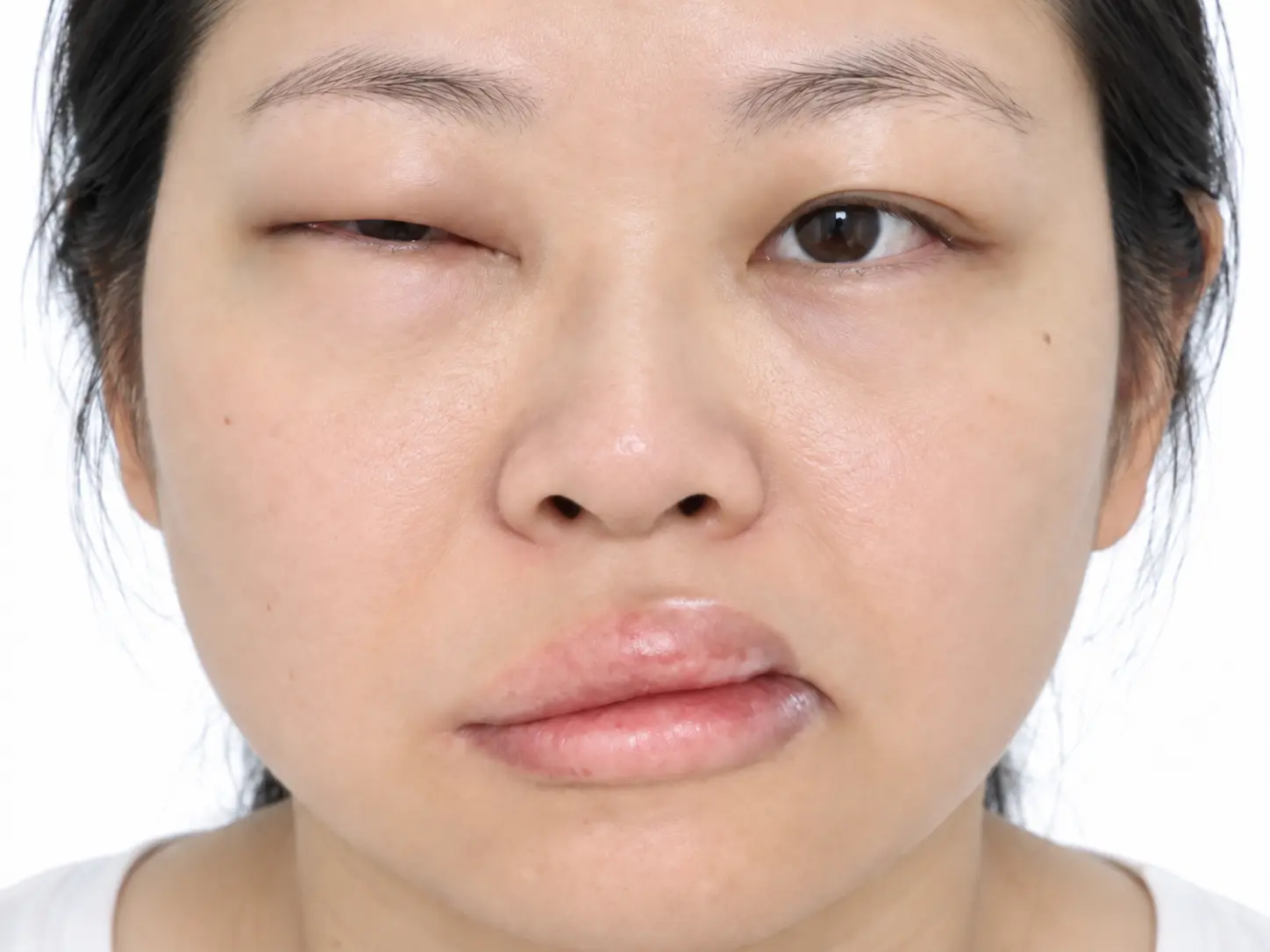 Precision care for fatal angioedema：Protecting rare diseases, keeping healthy and zero emergency
