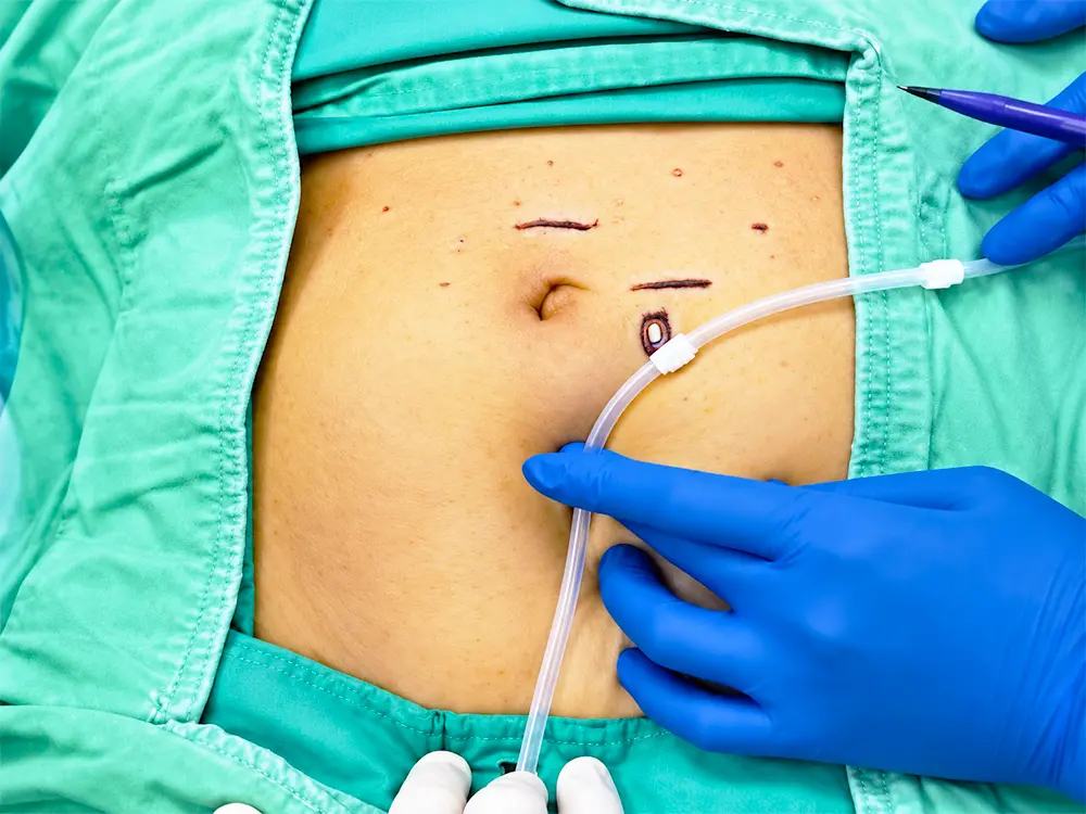 Improved Peritoneal Dialysis Catheter Care