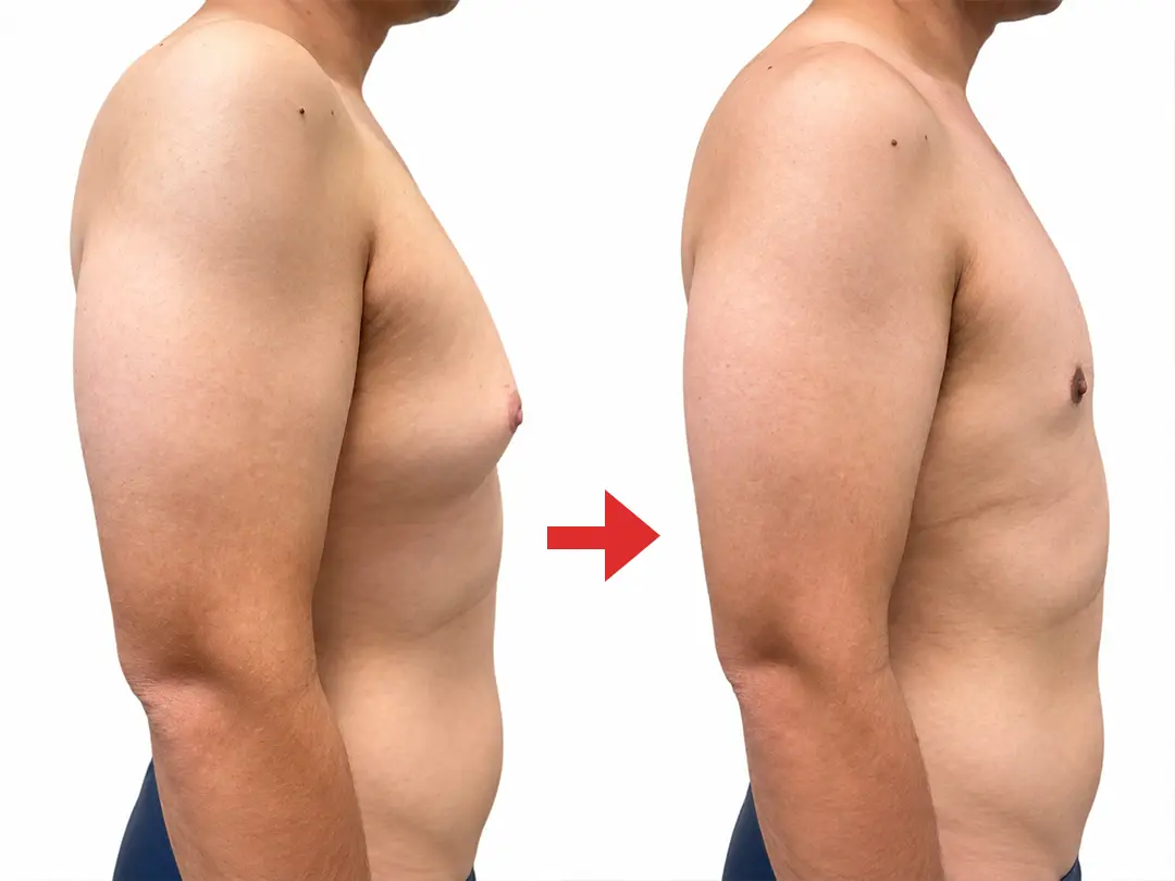 Confidence in Your Breast, Confidence Restored: A New Health Revolution for Gynecomastia