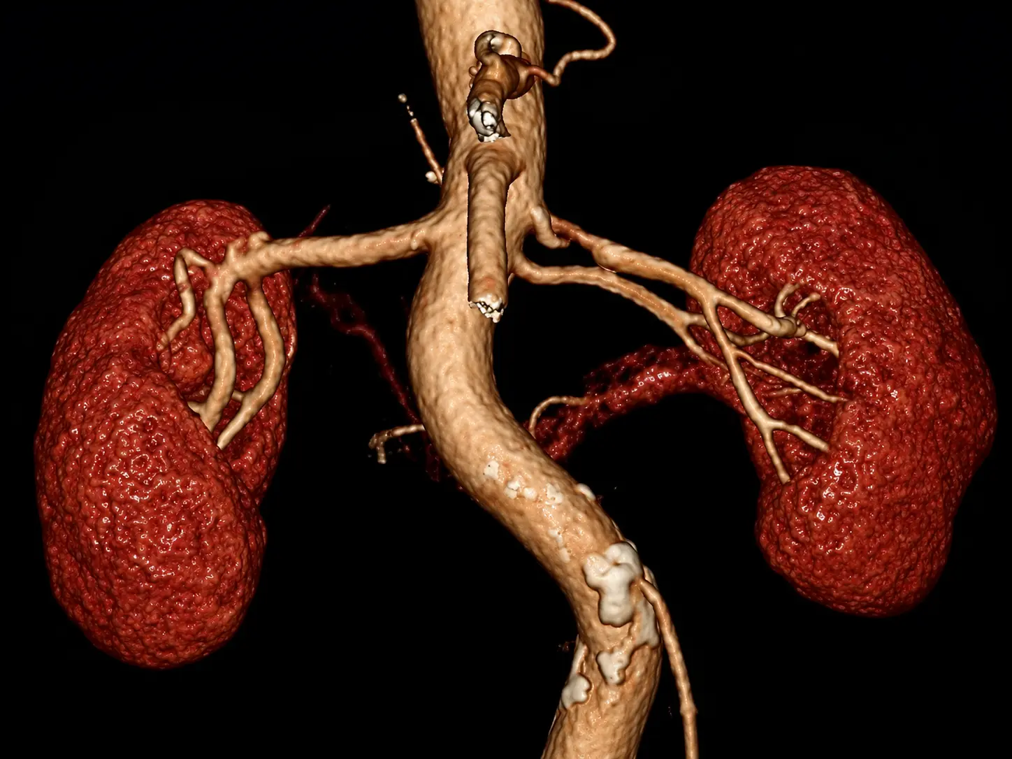 腎癌機器手臂腎元保留手術