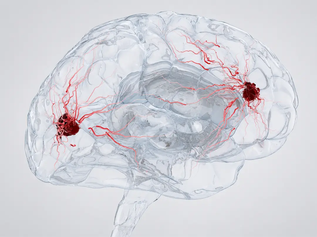 Precision Medicine for Brain Tumors
